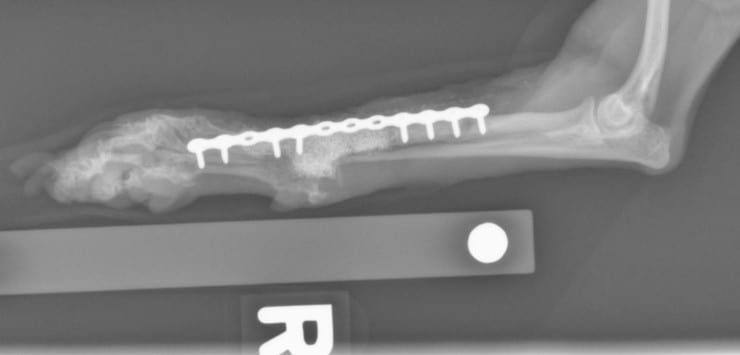 BMP bone regeneration post surgery