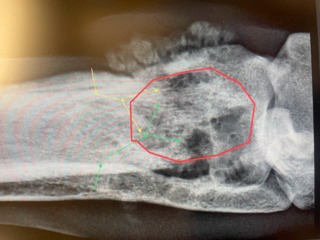 Osteosarcoma Bone Cancer Tumor in Colt's Leg
